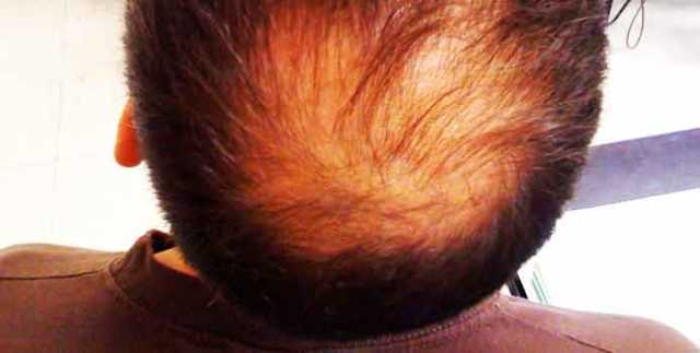 لماذا يتساقط شعر الإنسان وما هي مراحل نموه وطرق علاجه ؟!