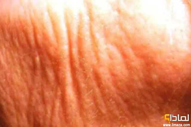 لماذا تظهر علامات تمدد الجلد وكيف يُمكن علاجها؟