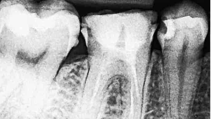 التواء الأسنان : لماذا يحدث التواء الأسنان وكيف يُعالج ؟