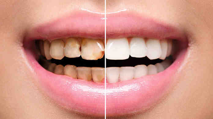 لماذا يحدث تصبغ الأسنان ؟ وما العوامل المسببة له؟