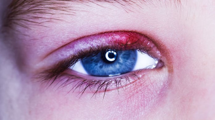 لماذا يحدث تورم جفن العين في بعض الأحيان وما علاجه؟